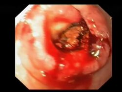 Bowel cancer. Endoscopic view of an adenoma, a malignant (cancerous) tumour, in the small intestine of a patient with coeliac disease.. Stock Footage