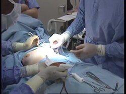 UK: BREAST IMPLANTS: LAST DAY FOR CLAIMS News Clip