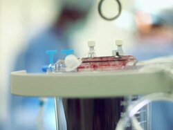 Doctors performing a surgery Stock Footage