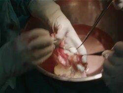 Heart surgeon and team prepare donor's heart before transfer to recipient patient Stock Footage