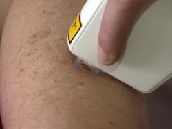 New Cancer Probe Diagnosis for Skin Cancer News Clip