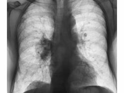 ZI on a chest x-ray showing lung cancer Stock Footage