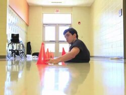 Caudal Regression Syndrome Victim Doug Forbis Stock Footage