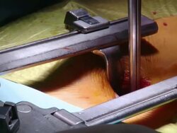  CU Surgeons operating / Cagliari, Sardinia, Italy Stock Footage