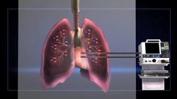 New technique could be a breakthrough in lung transplants Instructional Video