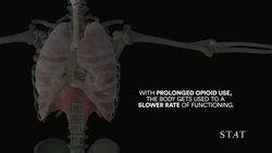 The Agony of Opioid Withdrawal Instructional Video