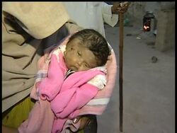 A baby with two faces was born in a northern Indian village, where she is being worshipped as the reincarnation of a Hindu goddess, her father said Tuesday. The baby apparently has a rare condition known as craniofacial duplication News Clip