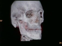 MS CT scan of human skull / Vermont, USA Stock Footage