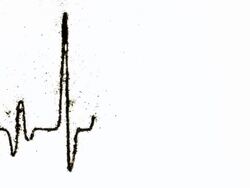 cardiogram Stock Footage