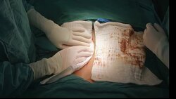 Surgeon perform explore laparotomy Stock Footage