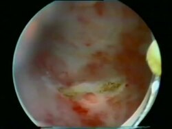 Endometrial resection. Stock Footage