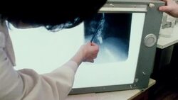 1970 MONTAGE Physicians reviewing esophageal x-ray films / London, England Stock Footage
