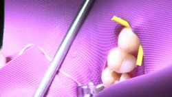 Repairing dental decay without fillings or drilling News Clip