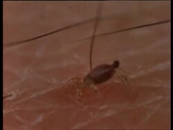 CU sequence of Head lice feeding, shows blood inside gut, United Kingdom; SEQUENCE OF CLIPS, SPECIAL TERMS APPLY Stock Footage