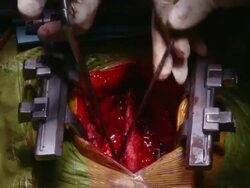 CU Doctors operating on surgery / Cagliari, Sardinia, Italy Stock Footage