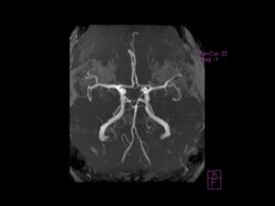 Circle of Willis. Rotating magnetic resonance angiography (MRA) scan of blood vessels in the circle of Willis (centre) in the brain. This network of arteries at the base of the brain supply the organ with oxygenated blood.. Stock Footage