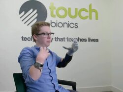 First UK Patient Showcases I-Limb Ultra Bionic Hand Stock Footage