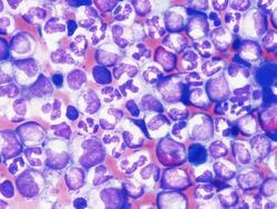 Microscopic image of human cancer cells chronic myelogenous leukemia Stock Footage