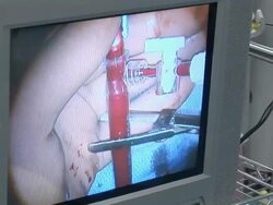 CU Monitor showing  doctors with blood tubes during surgery  /  Little Rock, Arkansas, USA Stock Footage