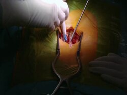 CU Surgeon operating on spine / Cagliari, Sardinia, Italy Stock Footage