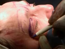 Facelift operation, clip 16 of 24. Stock Footage