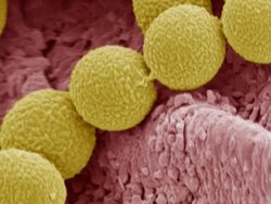 Athletes foot. Coloured scanning electron micrograph (SEM) of spores (yellow) of the fungus that causes athletes foot (Tinea pedis) on the skin of a human foot (pink). Stock Footage