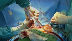 Surgery. Extraction of  liquid from the chest Stock Footage
