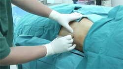 Doctor Incision Intercostal Space Stock Footage