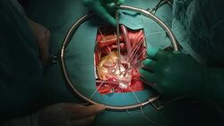 Surgeon Peeling calcified from mitreal leaflet Stock Footage