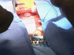 CU Doctors operating on child's heart surgery  /  Little Rock, Arkansas, USA Stock Footage