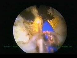 Laser prostate surgery. Endoscope image of a greenlight HPS laser inside the urethra of a patient undergoing a prostatectomy (removal of the prostate gland). The guide light is pink, the laser is yellow and dead cells are white.. Stock Footage