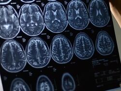 MRI Stock Footage