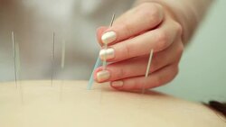 Acupuncture. Insertion of the needles Stock Footage
