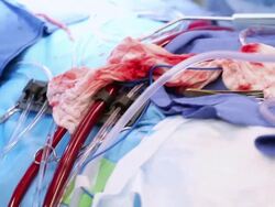 Doctors performing surgery Stock Footage