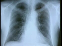 CU Full screen x-ray of chest Stock Footage