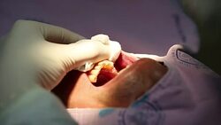 dental implant. Stock Footage