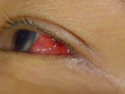 wait for cure clot on eye Stock Footage