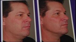 Ultrasound technology used to beat back age News Clip