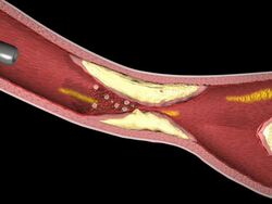 Balloon angioplasty and the insertion of a stent to widen an artery blocked by plaques of atheroma Stock Footage