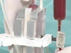 transfusion procedure (purification) of blood Stock Footage