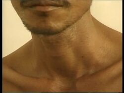 EAST TIMOR: W-H-O TUBERCULOSIS VACCINATION PROGRAMME News Clip