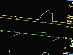 Ventilator monitor Stock Footage