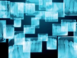 Dental X-Ray Stock Footage