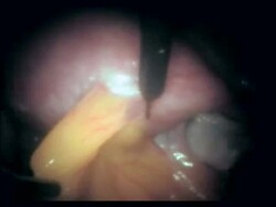 Abdominal adhesion first cut. Stock Footage