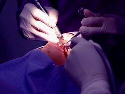 Dental Polishing teeth Stock Footage