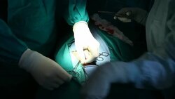 HD:Inguinal Hernia Surgery (5) Stock Footage