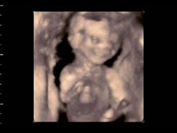 Foetus in the womb, 4D ultrasound scan.. Stock Footage