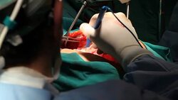 Close up view of open heart surgery Stock Footage