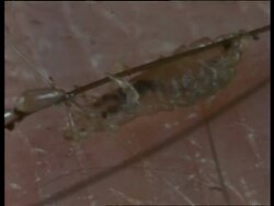 BCU female head louse secreting glue and laying eggs in hair, United Kingdom Stock Footage