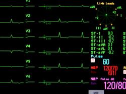 ECG monitor Stock Footage